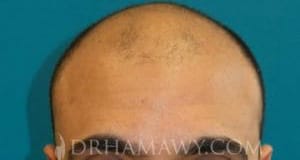 PRP Hair Restoration New Jersey