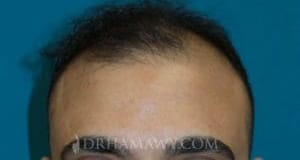 PRP Hair Restoration New Jersey