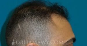 PRP Hair Restoration New Jersey