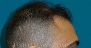 PRP Hair Restoration New Jersey