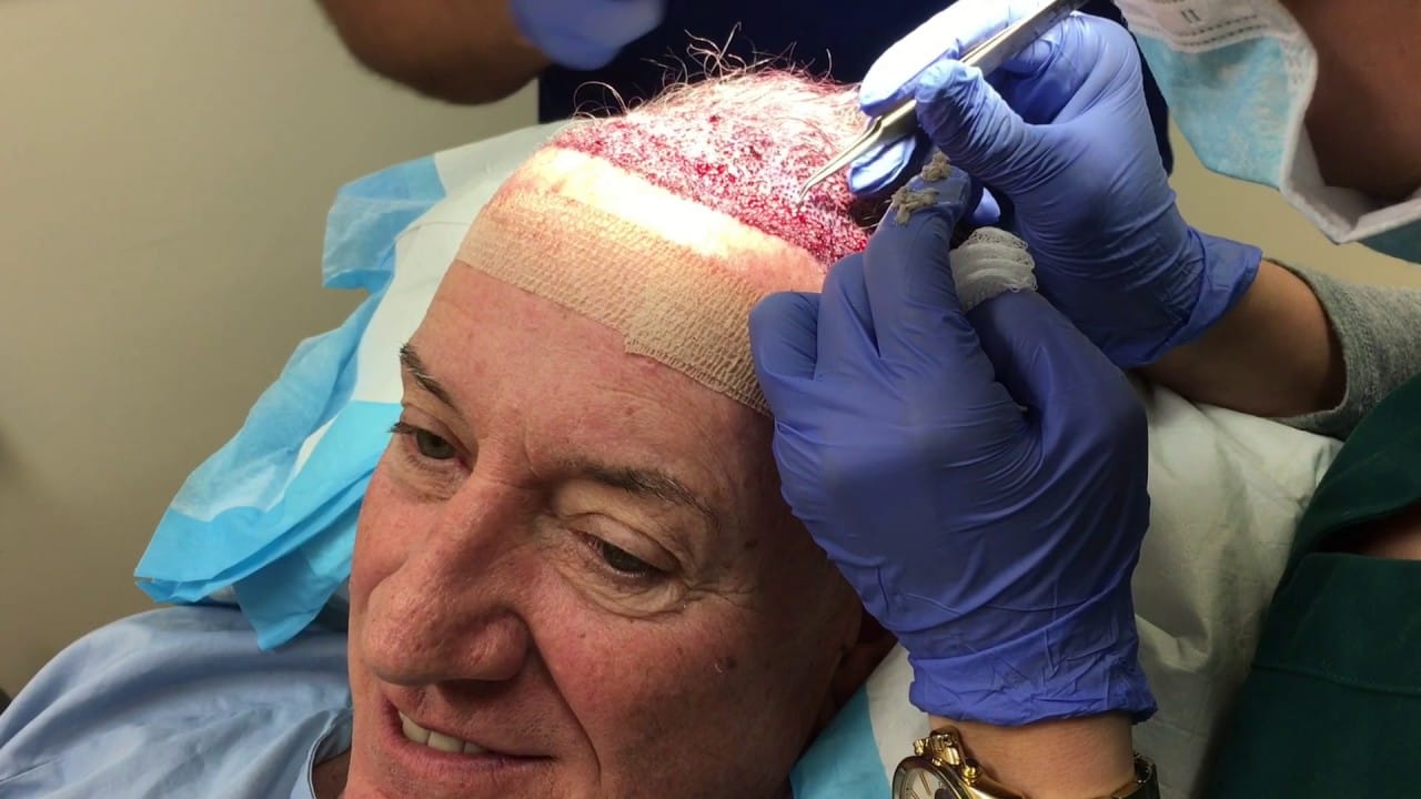 Hair Restoration New Jersey