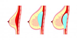 Breast Implant Placement Options