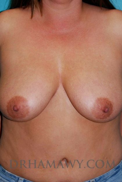 Breast Lift New Jersey