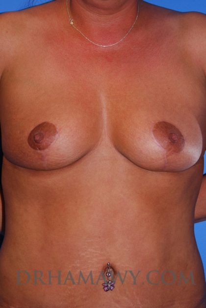 Breast Lift New Jersey