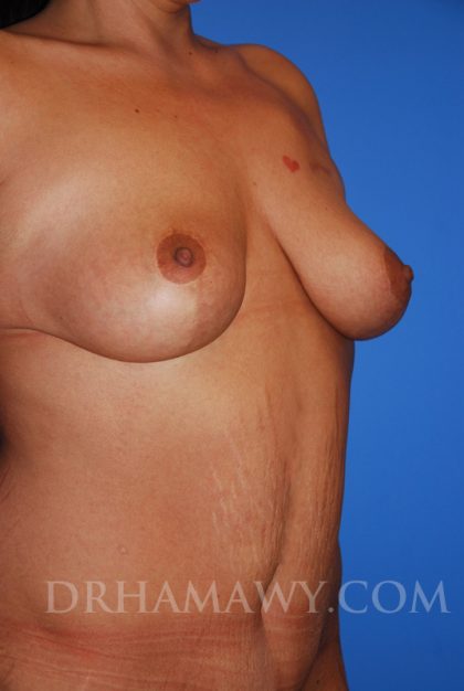 Breast Lift New Jersey