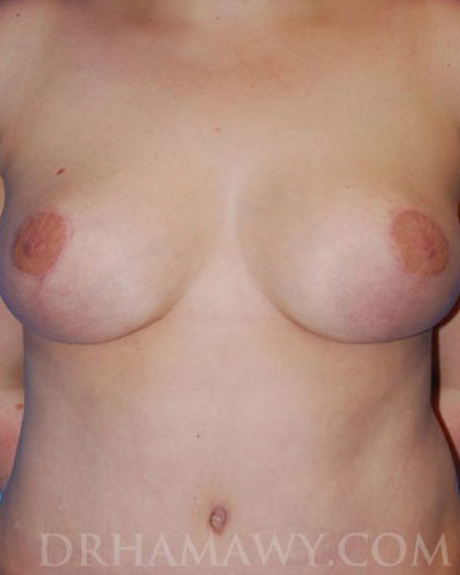 Patient 2 After Breast Reduction - Dr. Hamawy