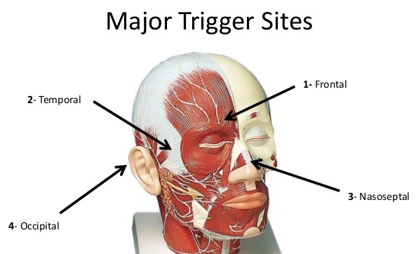 Migraine Surgery New Jersey