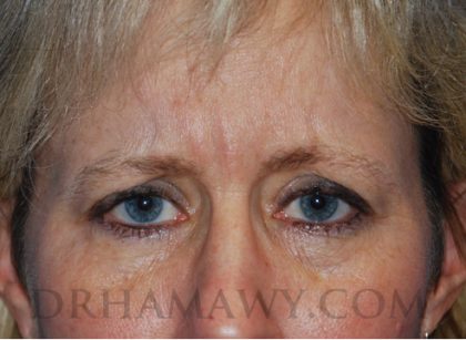 Botox Before and After | Princeton Plastic Surgeons