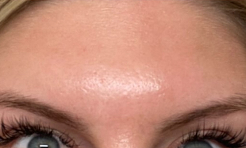 Botox Before and After | Princeton Plastic Surgeons