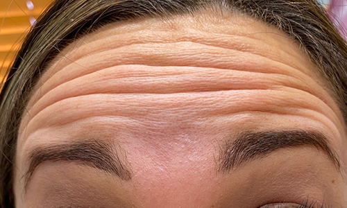 Botox Before and After | Princeton Plastic Surgeons