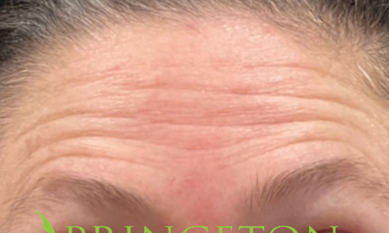 Botox Before and After | Princeton Plastic Surgeons