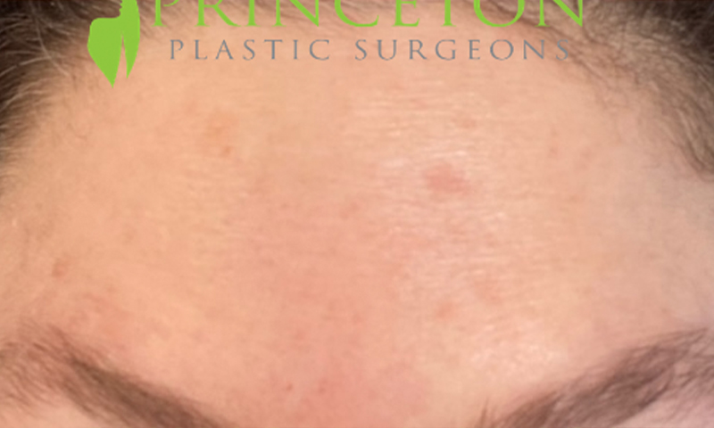 Botox Before and After | Princeton Plastic Surgeons