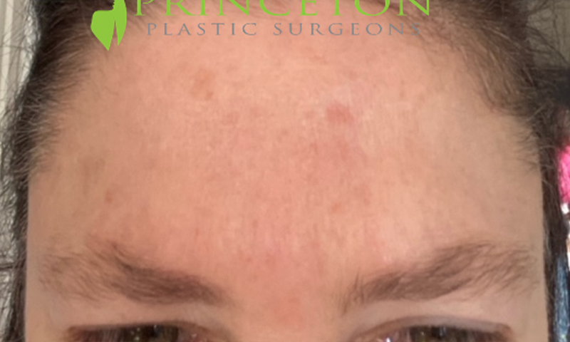 Botox Before and After | Princeton Plastic Surgeons