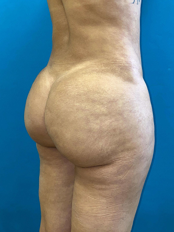 Brazilian Butt Lift Before and After | Princeton Plastic Surgeons