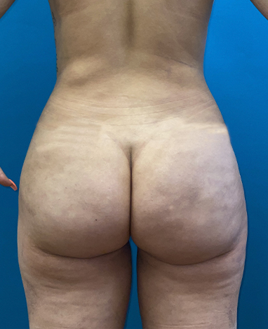 Brazilian Butt Lift Before and After | Princeton Plastic Surgeons