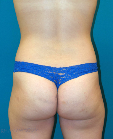 Brazilian Butt Lift Before and After | Princeton Plastic Surgeons