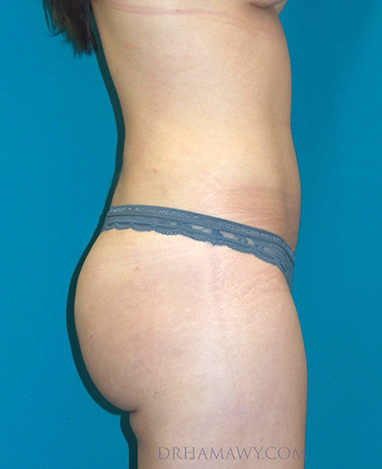 Brazilian Butt Lift Before and After | Princeton Plastic Surgeons