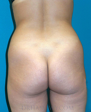 Brazilian Butt Lift Before and After | Princeton Plastic Surgeons