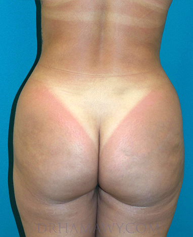 Brazilian Butt Lift Before and After | Princeton Plastic Surgeons