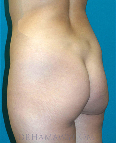 Brazilian Butt Lift Before and After | Princeton Plastic Surgeons