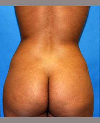 Brazilian Butt Lift Before and After | Princeton Plastic Surgeons