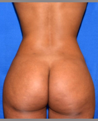 Brazilian Butt Lift Before and After | Princeton Plastic Surgeons