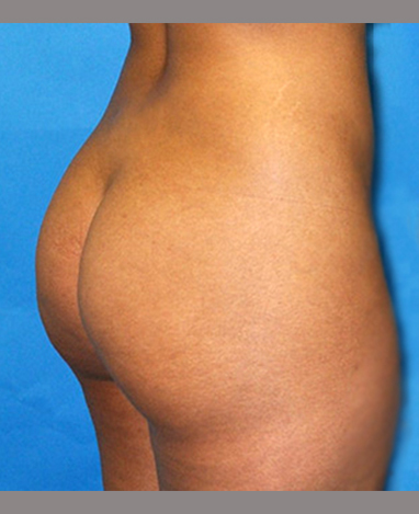 Brazilian Butt Lift Before and After | Princeton Plastic Surgeons