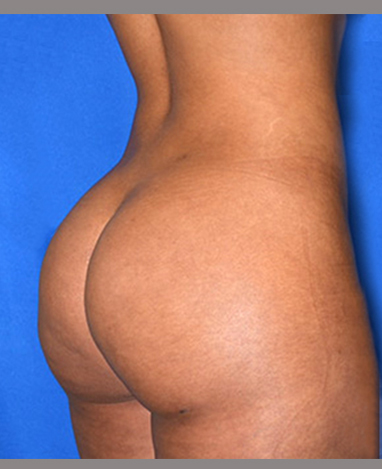 Brazilian Butt Lift Before and After | Princeton Plastic Surgeons