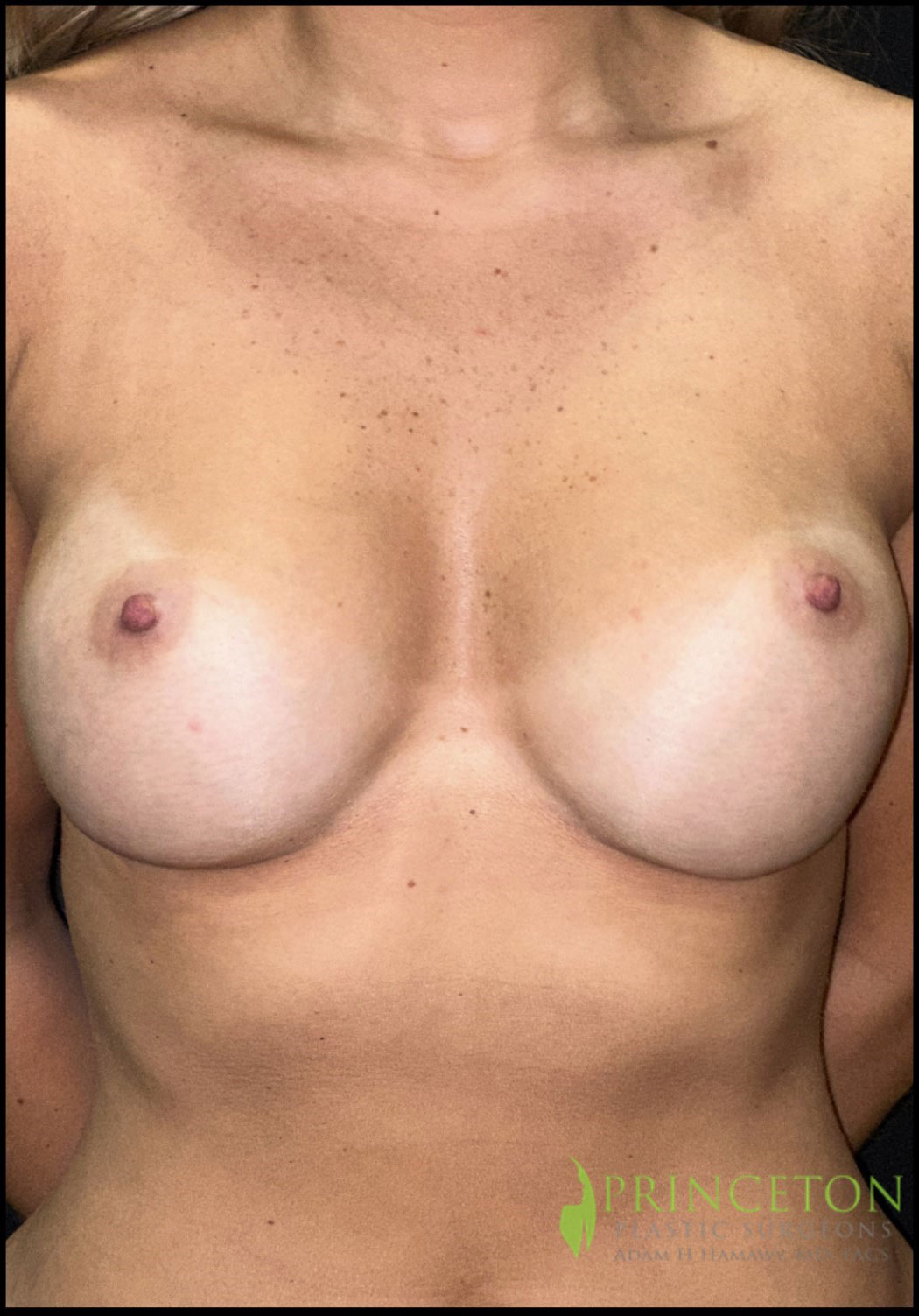 Breast Augmentation Before and After | Princeton Plastic Surgeons