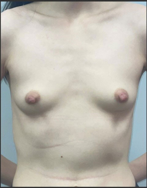 Breast Augmentation Before and After | Princeton Plastic Surgeons