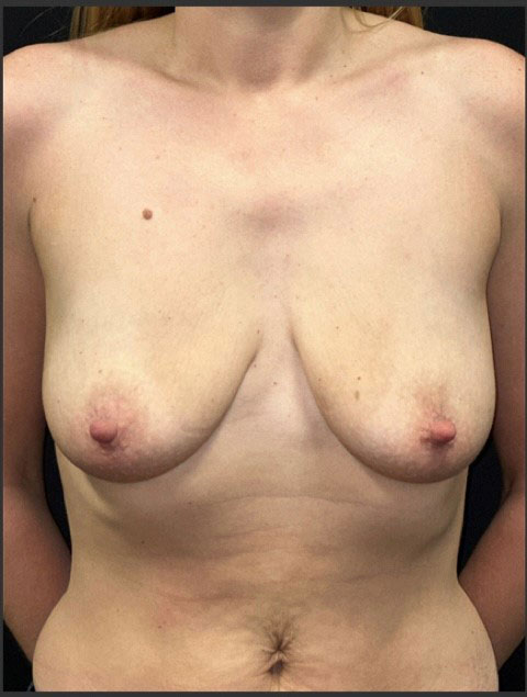 Breast Augmentation Before and After | Princeton Plastic Surgeons