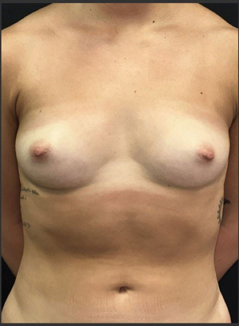 Breast Augmentation Before and After | Princeton Plastic Surgeons