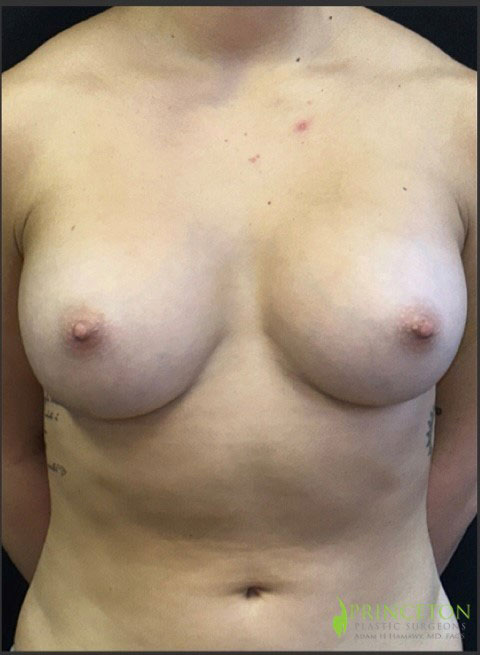 Breast Augmentation Before and After | Princeton Plastic Surgeons