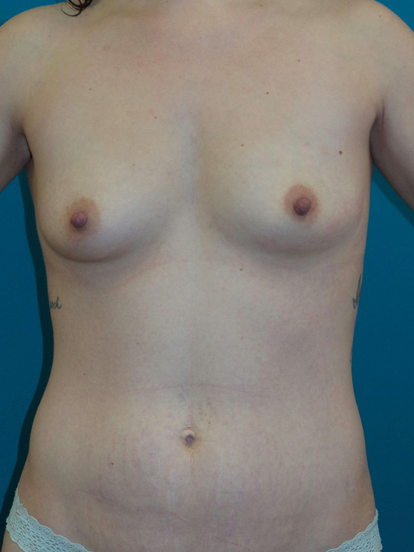 Breast Augmentation Before and After | Princeton Plastic Surgeons