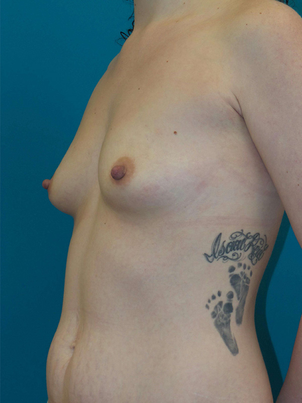 Breast Augmentation Before and After | Princeton Plastic Surgeons