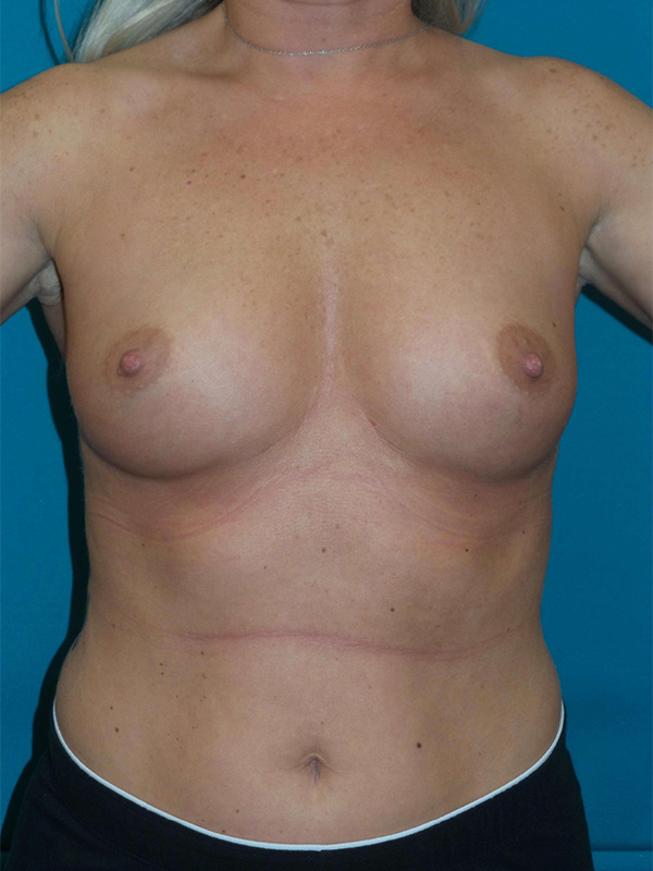 Breast Augmentation Before and After | Princeton Plastic Surgeons