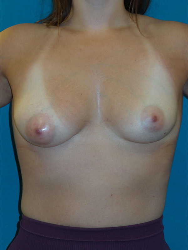 Breast Augmentation Before and After | Princeton Plastic Surgeons