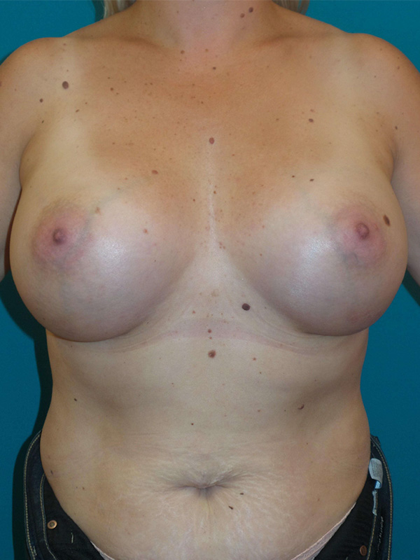 Breast Augmentation Before and After | Princeton Plastic Surgeons