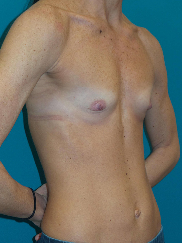 Breast Augmentation Before and After | Princeton Plastic Surgeons