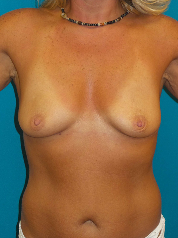 Breast Augmentation Before and After | Princeton Plastic Surgeons