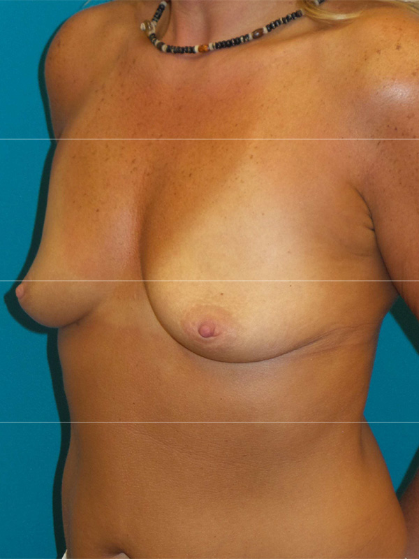 Breast Augmentation Before and After | Princeton Plastic Surgeons