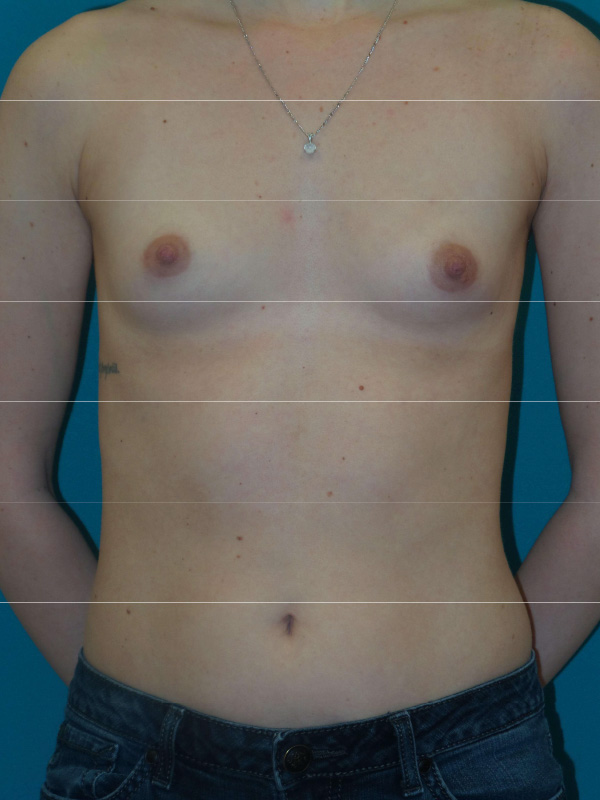 Breast Augmentation Before and After | Princeton Plastic Surgeons