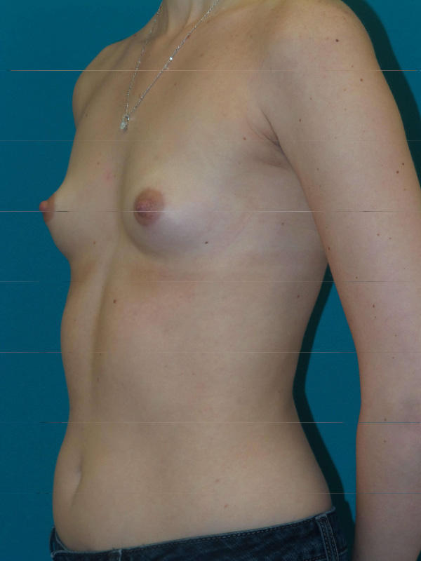 Breast Augmentation Before and After | Princeton Plastic Surgeons