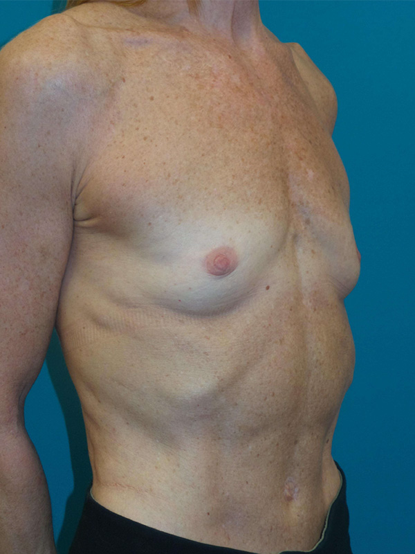 Breast Augmentation Before and After | Princeton Plastic Surgeons