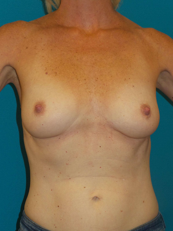 Breast Augmentation Before and After | Princeton Plastic Surgeons