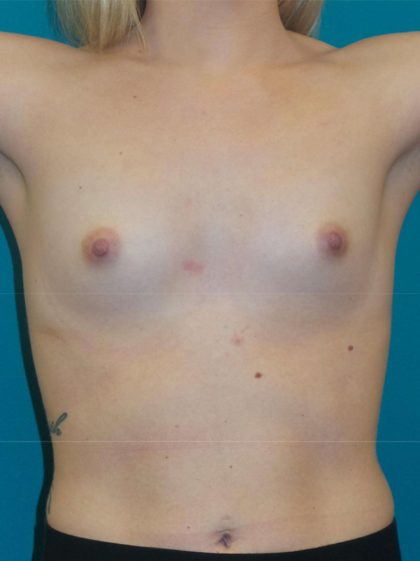 Breast Augmentation Before and After | Princeton Plastic Surgeons