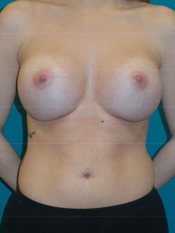 Breast Augmentation Before and After | Princeton Plastic Surgeons