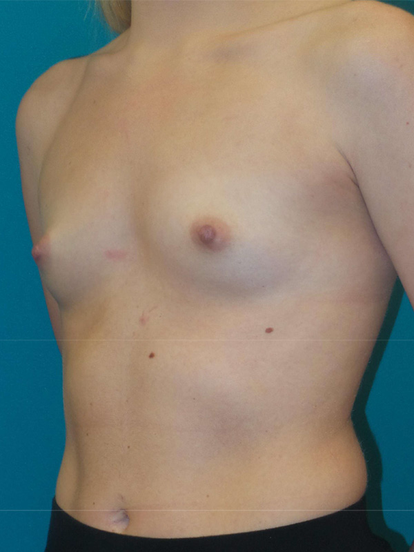 Breast Augmentation Before and After | Princeton Plastic Surgeons