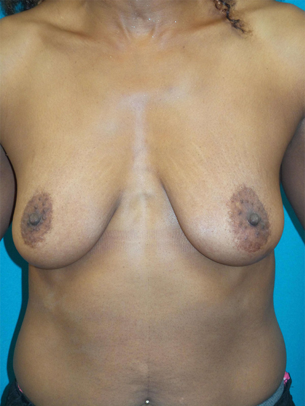 Breast Augmentation Before and After | Princeton Plastic Surgeons