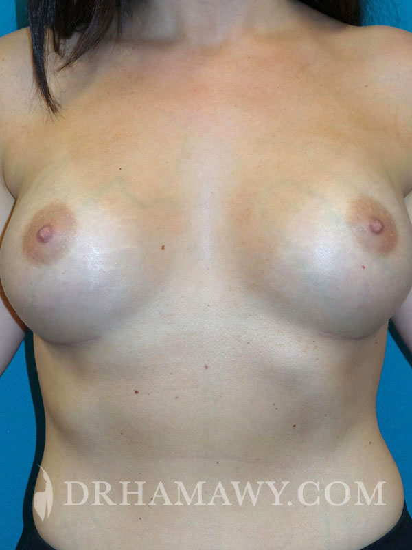 Breast Augmentation Before and After | Princeton Plastic Surgeons